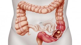 colon-retto