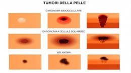 tumori della pelle
