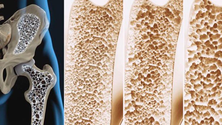 osteoporosi
